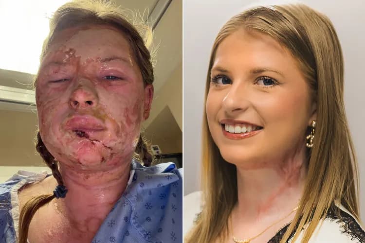 Side-by-side photos of Kaitlin Jeffrey after severe facial burns and later in recovery.
